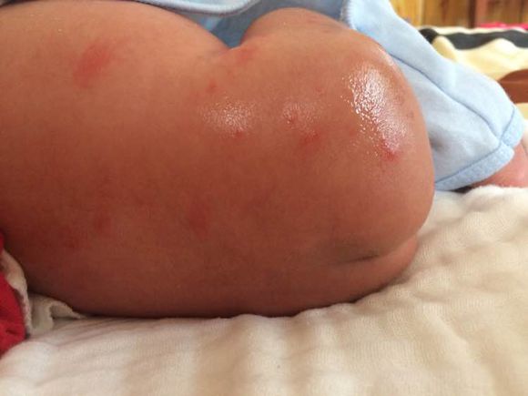 有尿布疹怎么办,尿布疹最快最有效的方法