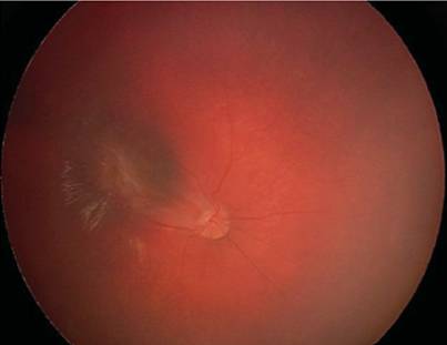 文摘速递儿童视网膜前膜手术的长期疗效