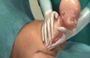 分娩时进行“剖腹产”手术全过程（附图）