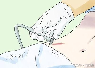 十几年刀疤疤痕修复的最新方法,疤痕修复的最新方法淡疤效果