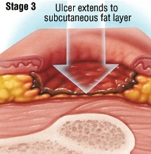 褥疮的护理和治疗方法,褥疮最怕的克星