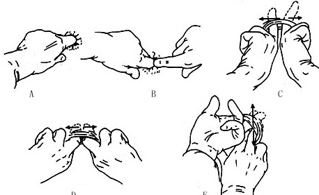 肛裂手术后25天亲身经历,肛裂手术后患者的感受