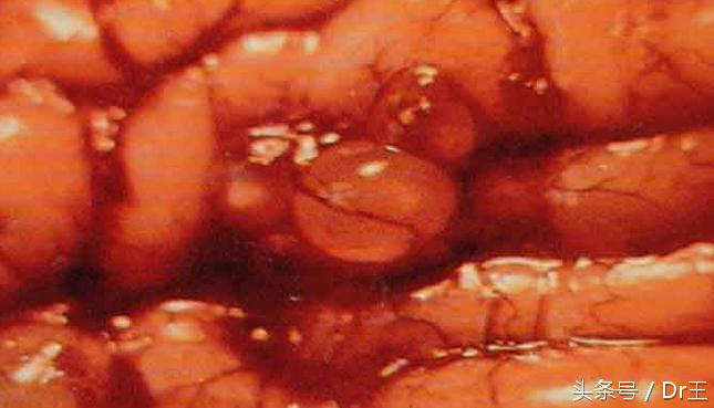 生吃鼯鼠肉，男子竟罹患急性胆囊炎！