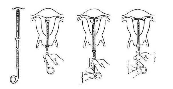 取环详细手术记录,取环术手术步骤