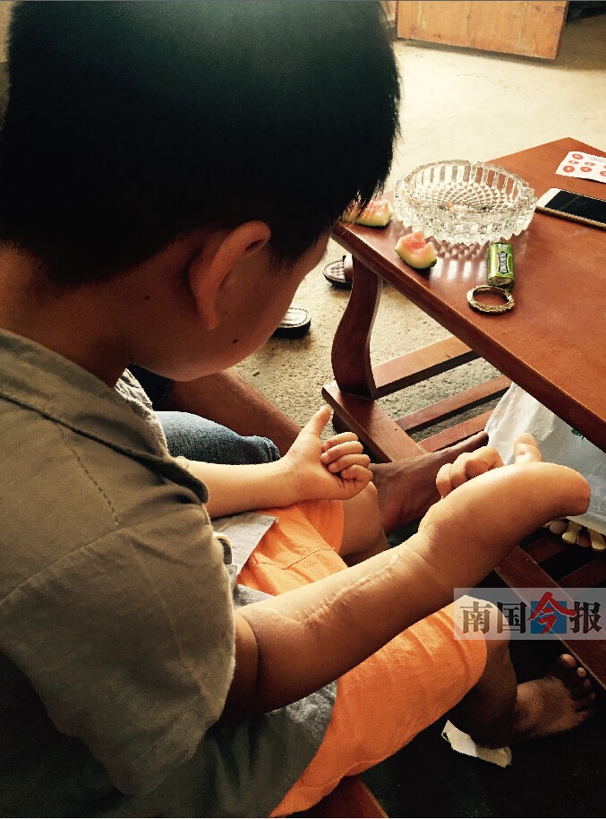 巨指男孩变成阳光少年憧憬治好手到大城市读书