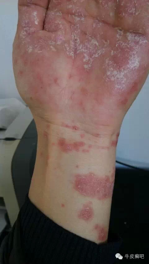 医院专家教你治疗牛皮癣,专家专治牛皮癣方法