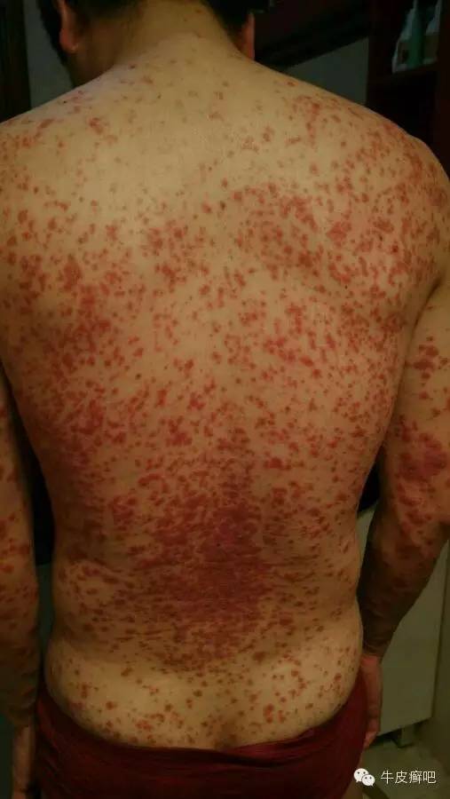 医院专家教你治疗牛皮癣,专家专治牛皮癣方法