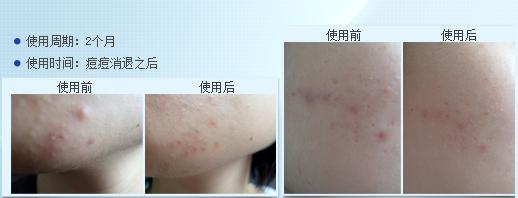 你知道如何挑选祛疤产品吗？三款知名祛疤膏对比