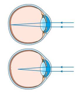 辟谣特工队|一招恢复视力，敢信吗？