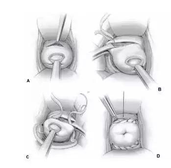 子宫颈内口松弛会造成不孕吗,宫颈内口松弛流产几率