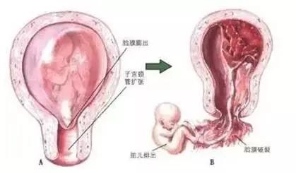 宫颈内口松弛是什么原因引起,宫颈内口松弛行宫颈环扎术时间