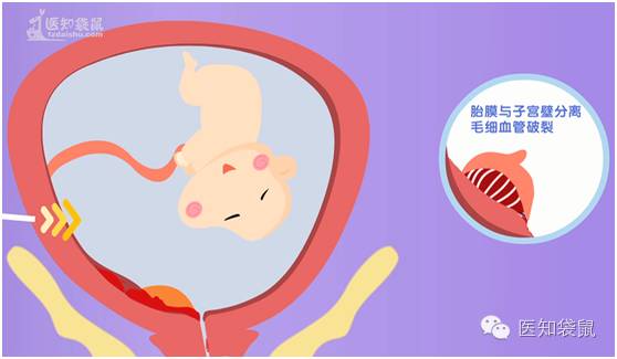 孕妇临产前的几种征兆,孕妇临产前有哪些征兆