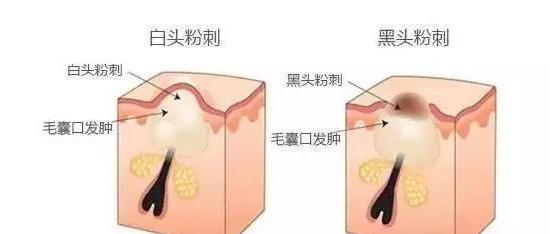 什么是粉刺闭合性粉刺图片,什么是粉刺该如何治疗