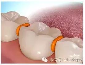 常见排齐牙齿的四大方法,牙齿拥挤重叠矫正过程