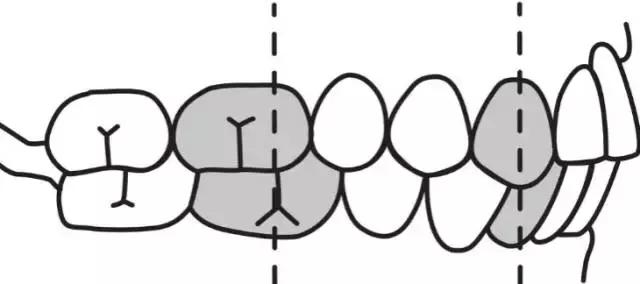 牙齿矫正是拔牙多好还是少好,为什么牙齿矫正一般都要拔牙
