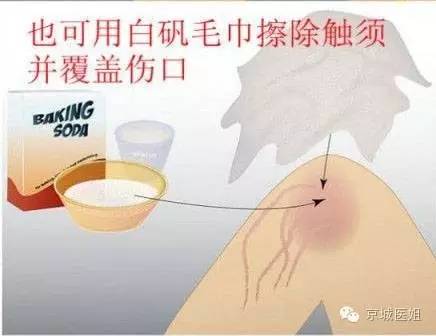 被水母刺到怎么办,水母蜇伤现场急救处理