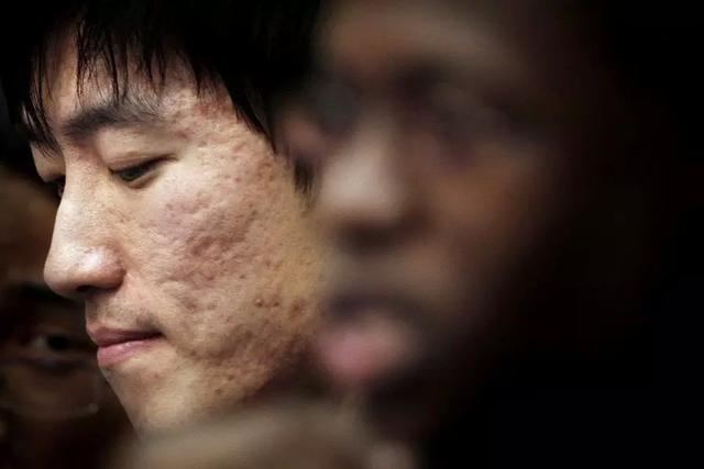 常年长痘的皮肤怎么调理回来,经常长痘如何快速消除