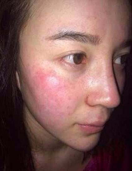 红血丝敏感肌肤怎么修复好,屏障受损敏感红血丝肌肤怎么修复