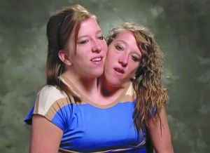 两个女生共用一个身体,共用一个头的连体双胞胎女孩