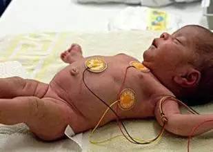 父母应该高度重视的新生儿肺炎！