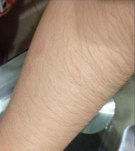 痘痘很顽固就是下不去,痘痘很严重的女孩