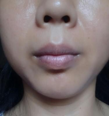 为什么剥脱性唇炎那么难好,剥脱性唇炎是细菌还是病毒