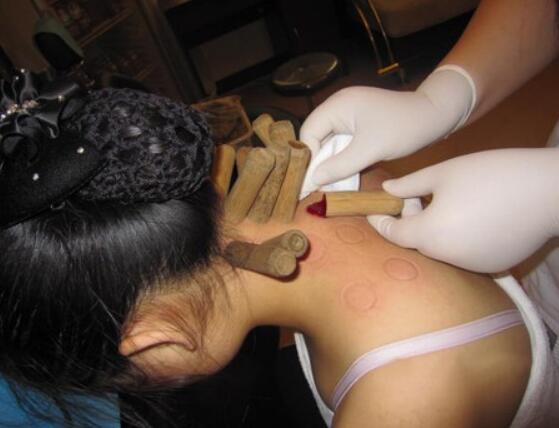 非遗药物竹罐的传承,非遗文化传承竹罐