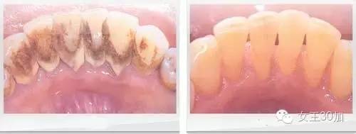 新美容|唇膏买嗨了,可你的牙配得上这些唇膏吗?