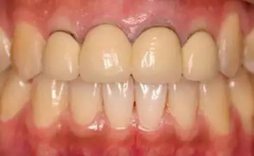 烤瓷牙变黑有必要更换吗,烤瓷牙边缘变黑怎么办