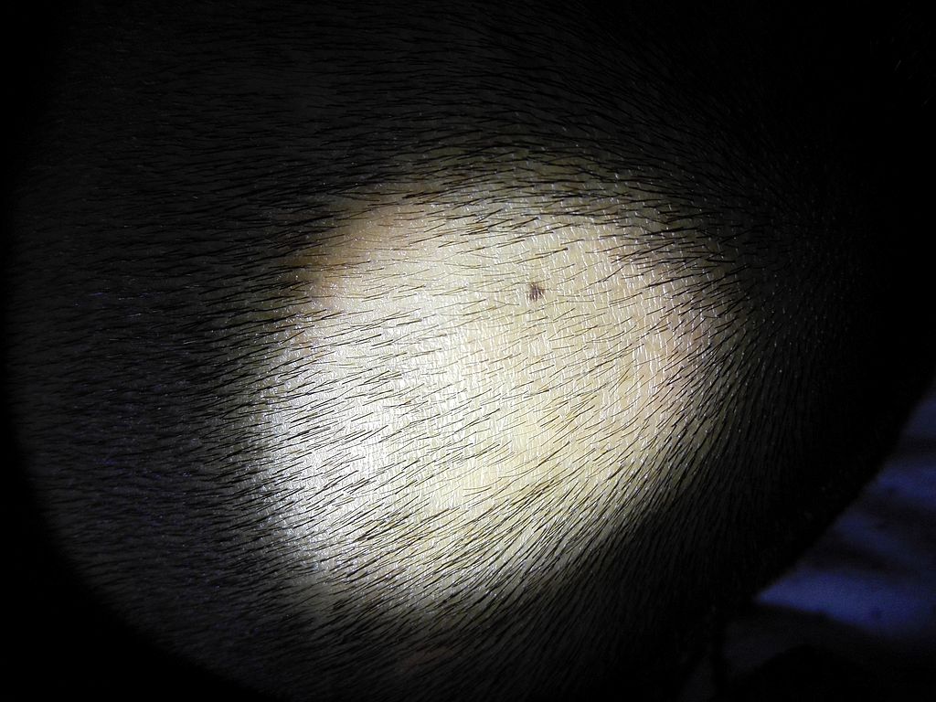 15岁斑秃中医辨证论治,21岁男生斑秃可以自愈吗