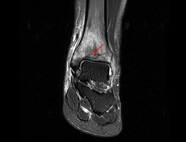 疲劳性骨折诊断,容易被忽略的骨科病