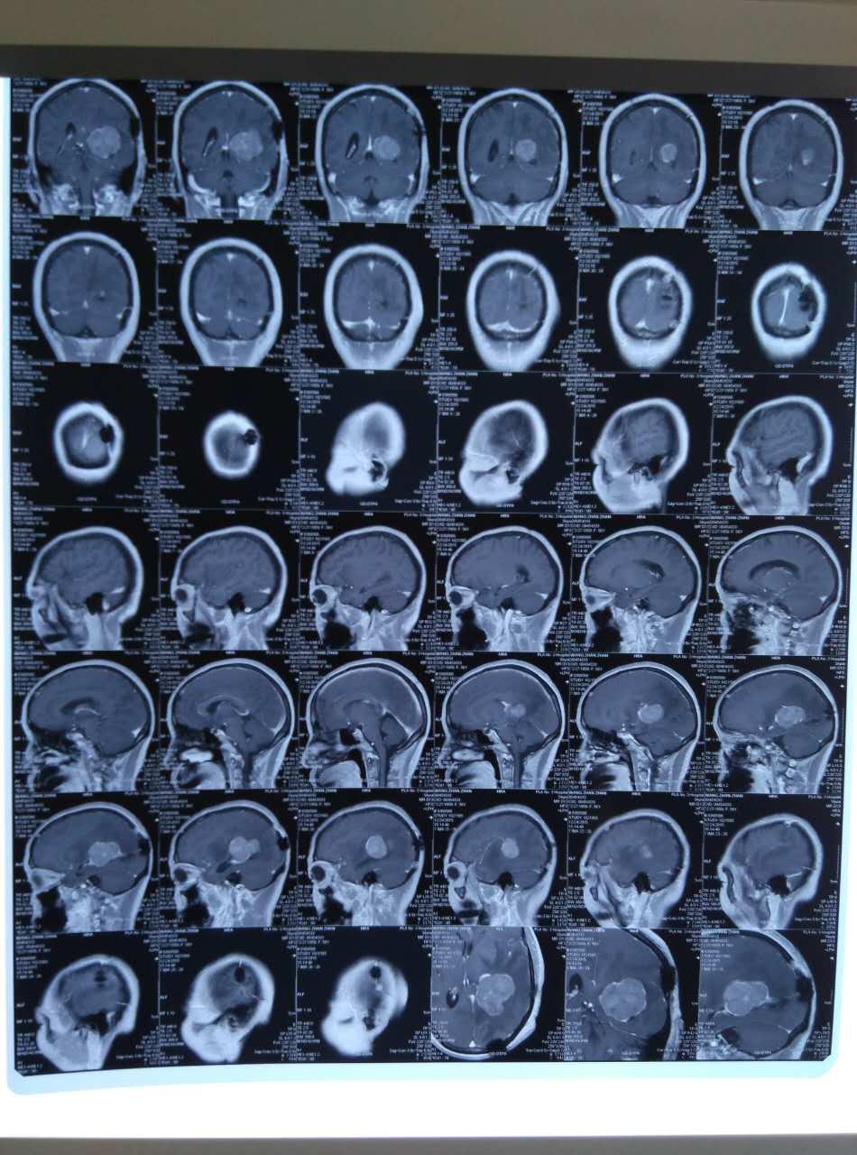 脑胶质瘤复发怎么处理,脑胶质瘤复发怎么治疗