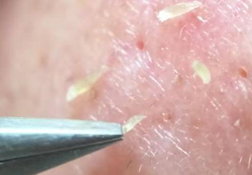 第一次刷酸去黑头新手教程,黑头处理工具用法