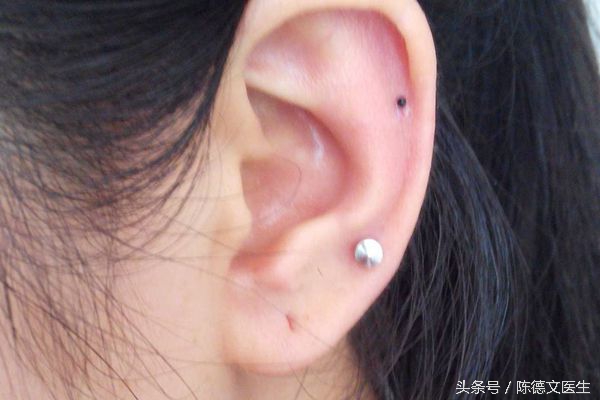 耳洞发炎有脓怎样安全让它长回去,耳洞发炎红肿化脓什么样子