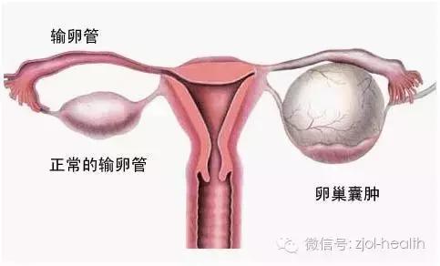 生孩子被切除卵巢,生孩子卵巢切除
