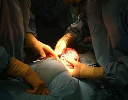 剖腹产轻松,剖腹产其实也是比较好的吧