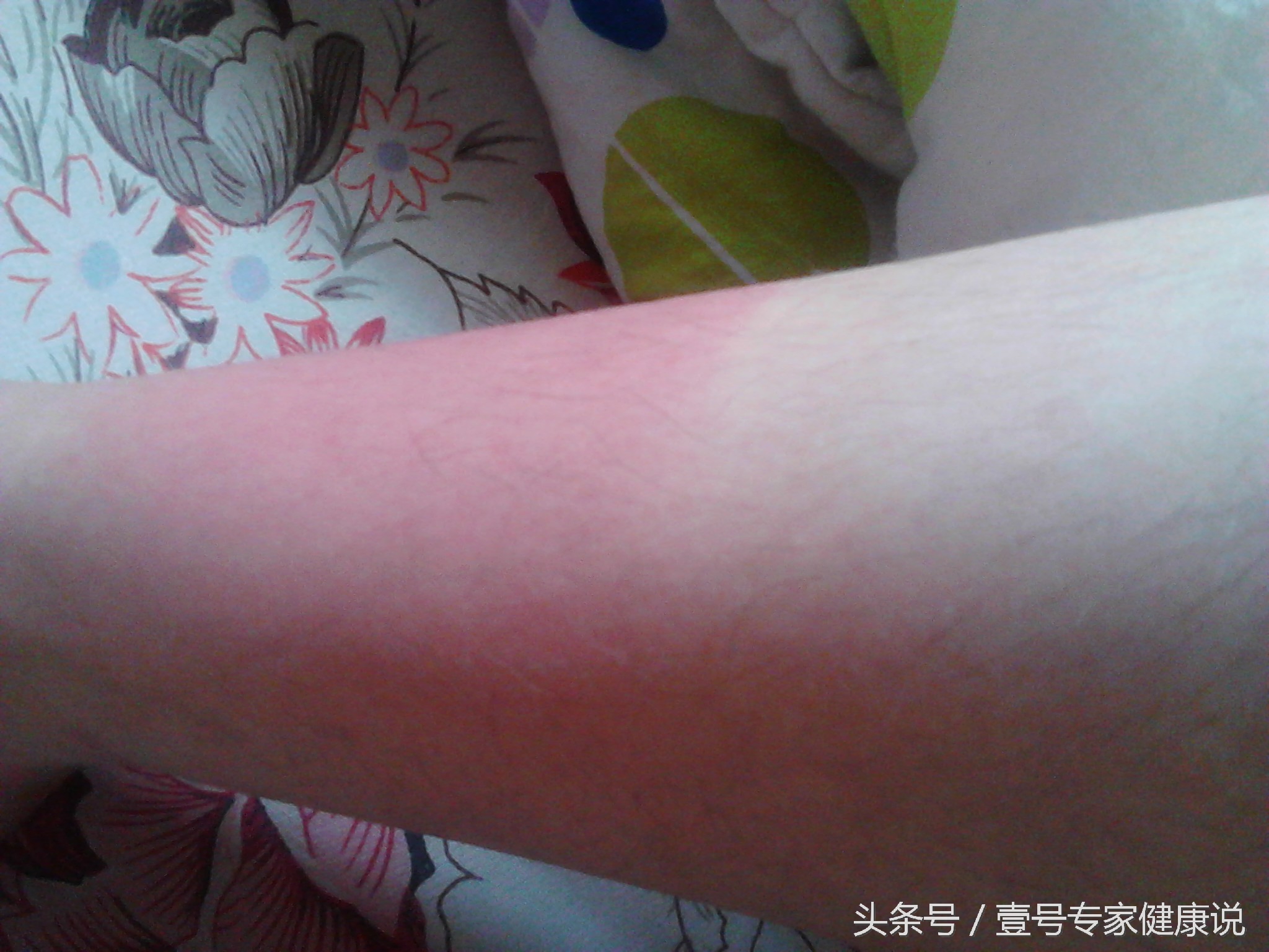 烫伤扭伤急救方法和注意事项,刺伤流血怎么急救