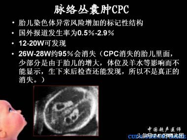 胎儿左侧脉络丛囊肿26周复查增大,胎儿脉络丛囊肿隔多久检查一次