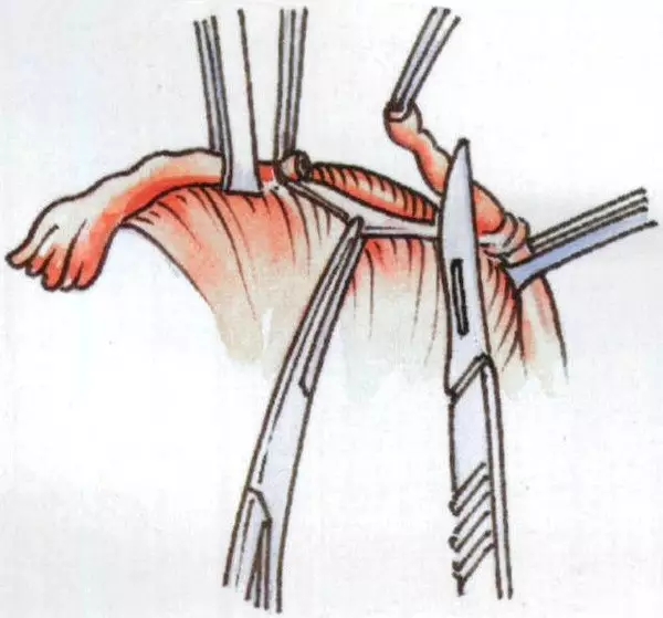 女性二胎后做结扎有影响吗,二胎结扎后想生三胎