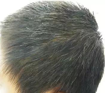 少白头怎么变黑小百科来普及