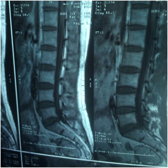 微医在线问诊可以约手术吗,九年的腰椎间盘突出能不能做微创