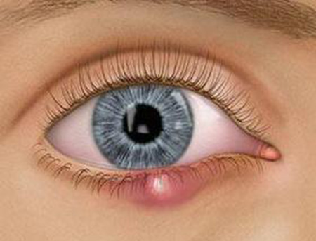 眼皮肿了有个小疙瘩怎么回事,针眼会引起眼皮肿吗