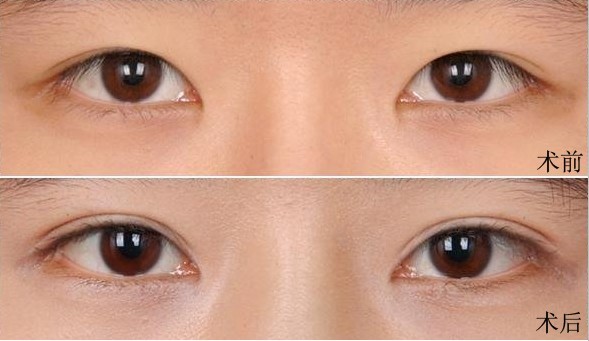 为什么大家都喜欢大眼睛双眼皮,为什么大家喜欢做双眼皮手术