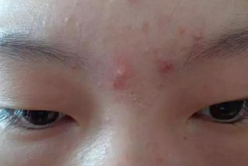 疮疡诊断要点是什么,1期压疮的护理要点