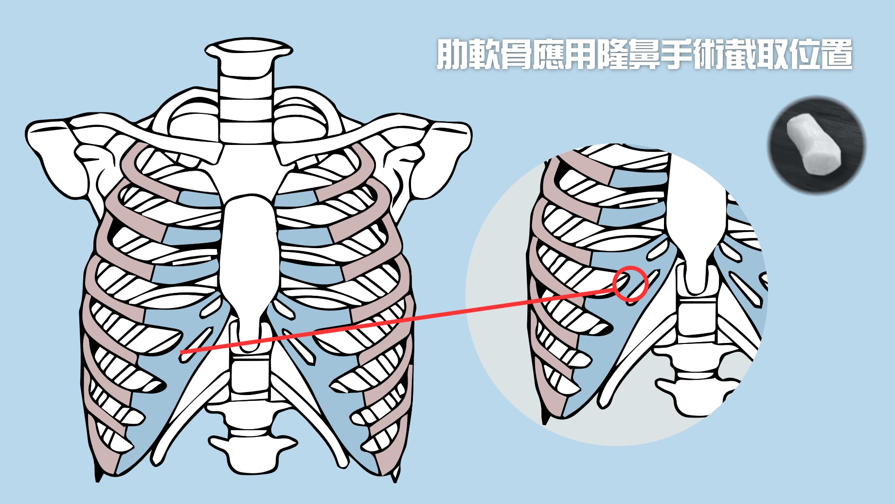 隆鼻太可怕怎么办,硅胶隆鼻正确方法图