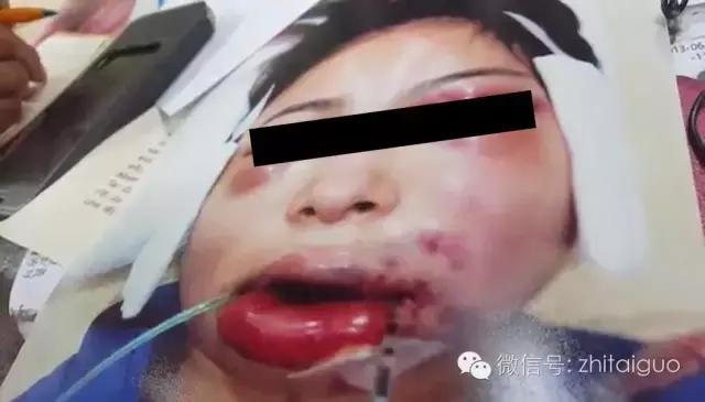 整容失败有多可怕,整容失败多可怕