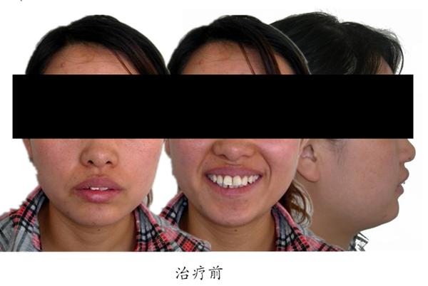 拔牙有风险拔牙需谨慎,拔牙后果严重吗