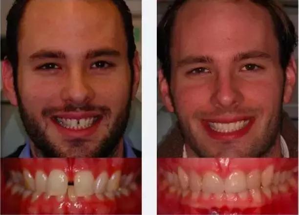 前牙有缝有什么说法吗,前牙有洞怎么补救