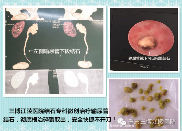 深圳哪个医院治疗结石最好,深圳治疗结石的方法