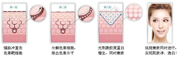 激光祛斑和皮秒祛斑哪个效果好,彩光祛斑和激光祛斑的区别是什么
